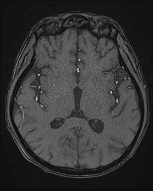 File:Cerebral embolic infarcts (embolic shower) (Radiopaedia 72391-82921 Axial MRA 94).jpg
