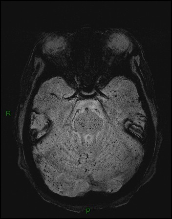 Cerebral fat embolism (Radiopaedia 35022-36525 Axial SWI 1).jpg