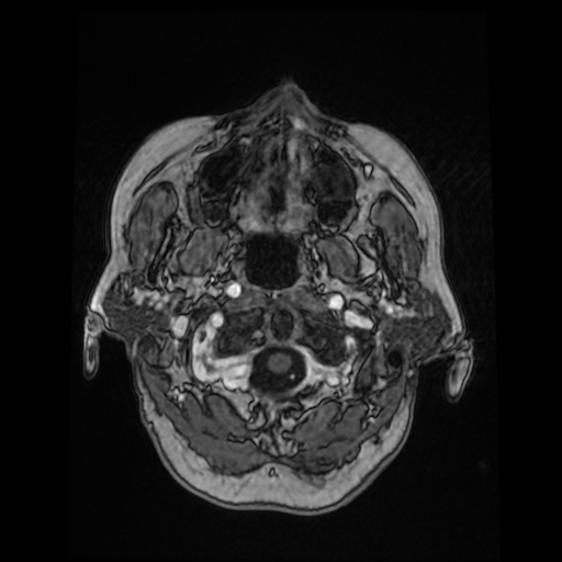 Cerebral metastases - melanoma (Radiopaedia 80972-94522 Axial T1 C+ 20).jpg