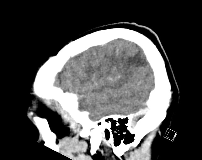 Cerebral metastases - testicular choriocarcinoma (Radiopaedia 84486-99855 F 12).jpg