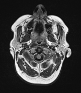 File:Cerebral metastases mimicking abscesses (Radiopaedia 45841-50131 Axial FLAIR 1).png