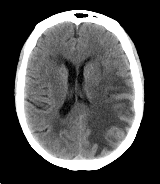 File:Cerebral metastasis (Radiopaedia 46744-51247 Axial non-contrast 18).png