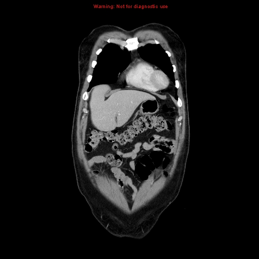Cerebral metastasis - colorectal carcinoma (Radiopaedia 8581-83548 A 18).jpg