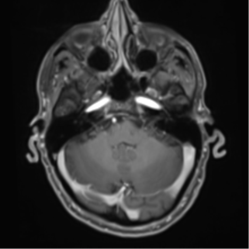 Cerebral metastasis - melanoma (Radiopaedia 54718-60954 Axial T1 C+ fat sat 14).png