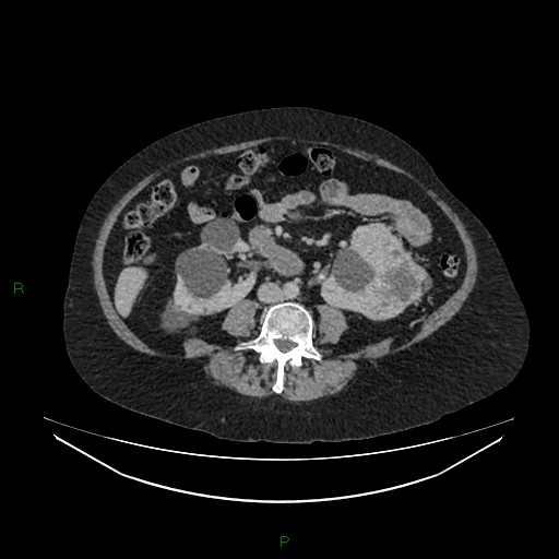 Cerebral metastasis from renal cell carcinoma (Radiopaedia 82306-96378 A 101).jpg