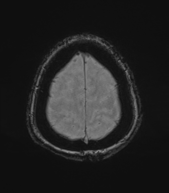 Cerebral metastasis to basal ganglia (Radiopaedia 81568-95413 Axial SWI magnitude 78).png