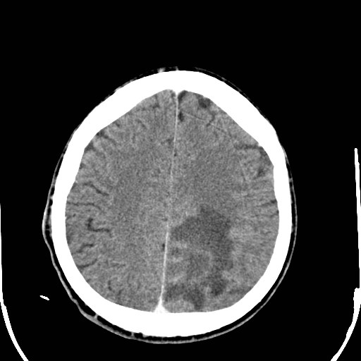 File:Cerebral toxoplasmosis (Radiopaedia 43956-47460 Axial C+ delayed 30).jpg