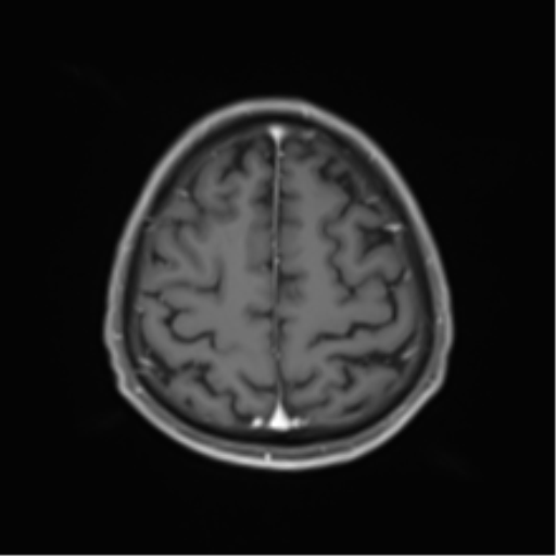Cerebral toxoplasmosis (Radiopaedia 54575-60804 Axial T1 C+ 44).png