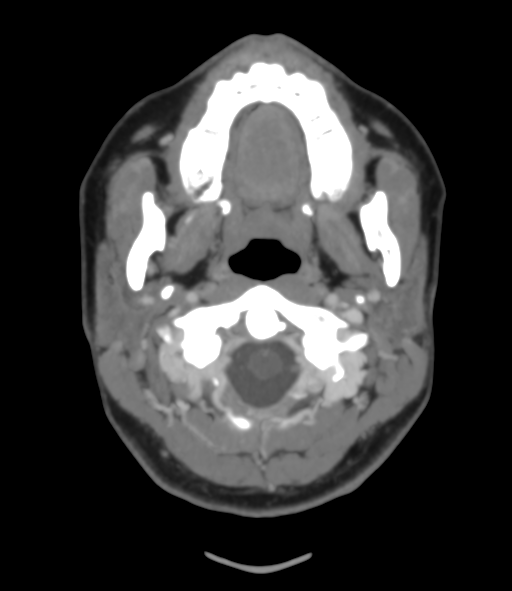 Cerebral venous hemorrhagic infarction (Radiopaedia 38461-40550 Axial MIP VENOGRAM 3).png