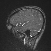 Cerebral venous infarction - hemorrhagic (Radiopaedia 81625-95505 Sagittal MRV 61).jpg