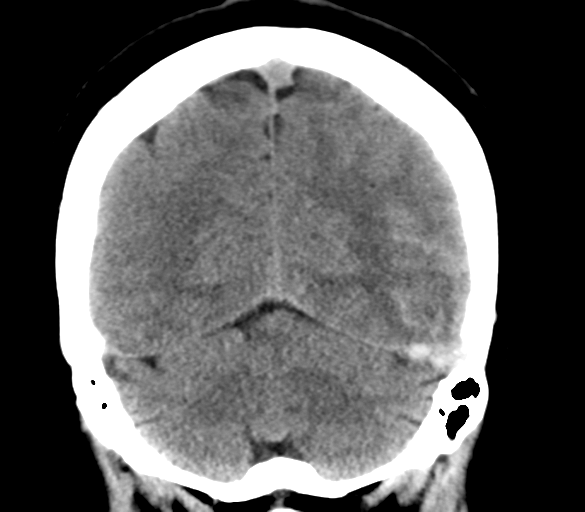 File:Cerebral venous infarction due to transverse sinus thrombosis (Radiopaedia 34688-36116 Coronal non-contrast 28).png
