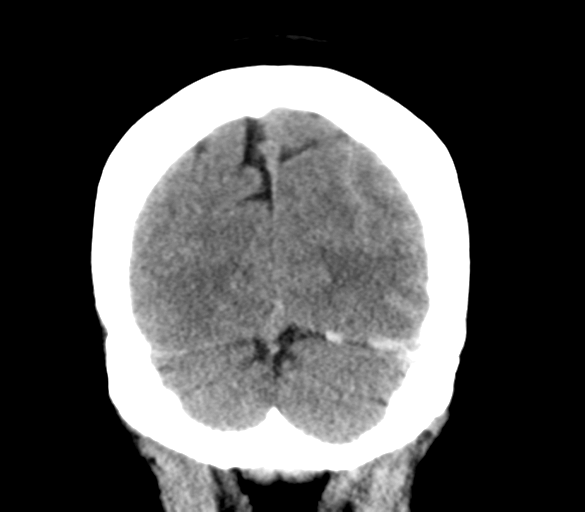File:Cerebral venous infarction due to transverse sinus thrombosis (Radiopaedia 34688-36116 Coronal non-contrast 31).png