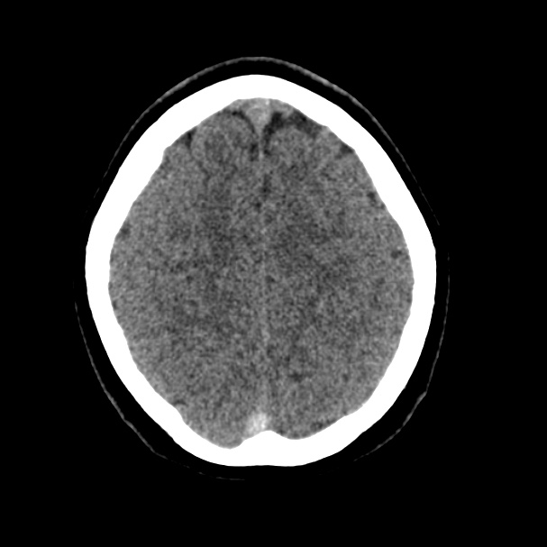 Cerebral venous sinus thrombosis (Radiopaedia 59224-66551 Axial non-contrast 36).jpg