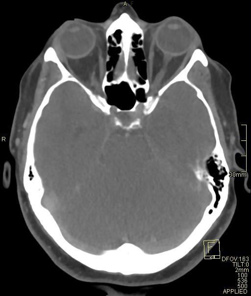 Cerebral venous sinus thrombosis (Radiopaedia 91329-108965 Axial venogram 29).jpg