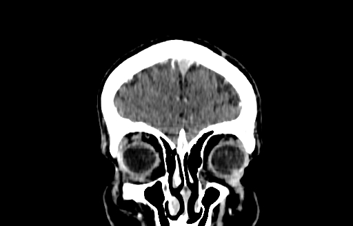 Cerebral venous thrombosis (CVT) (Radiopaedia 77524-89685 C 5).jpg