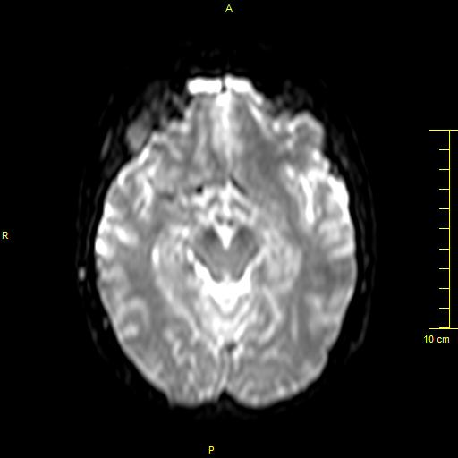 File:Cerebral venous thrombosis (Radiopaedia 23288-23351 Axial DWI 14).JPG