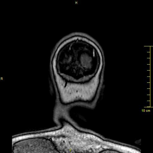 Cerebral venous thrombosis (Radiopaedia 23288-23351 MRV 178).JPG