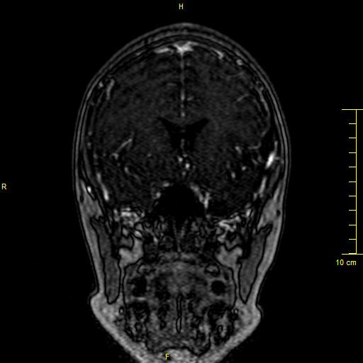 Cerebral venous thrombosis (Radiopaedia 23288-23351 MRV 40).JPG