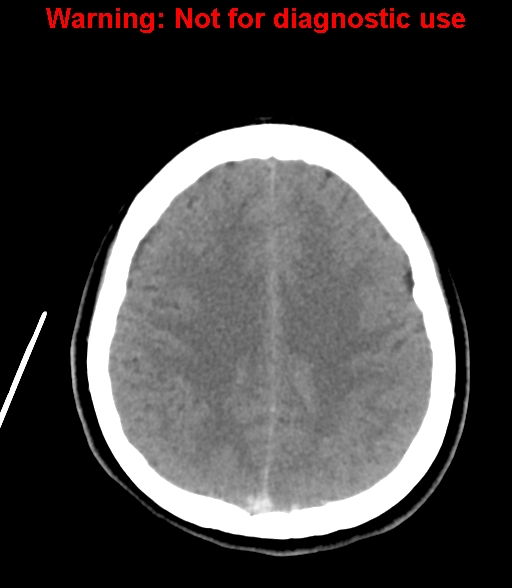 File:Cerebral venous thrombosis (Radiopaedia 37224-38992 Axial non-contrast 21).jpg