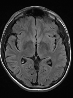 File:Cerebral venous thrombosis (Radiopaedia 38392-40469 Axial FLAIR 12).png