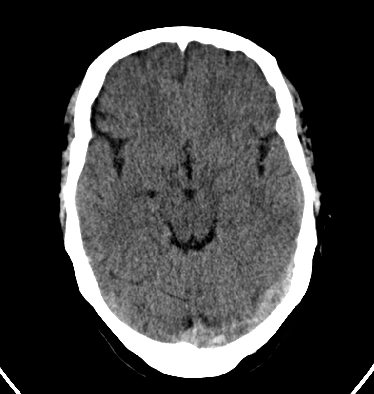 Cerebral venous thrombosis - CT only (Radiopaedia 41031-43778 Axial non-contrast 53).jpg