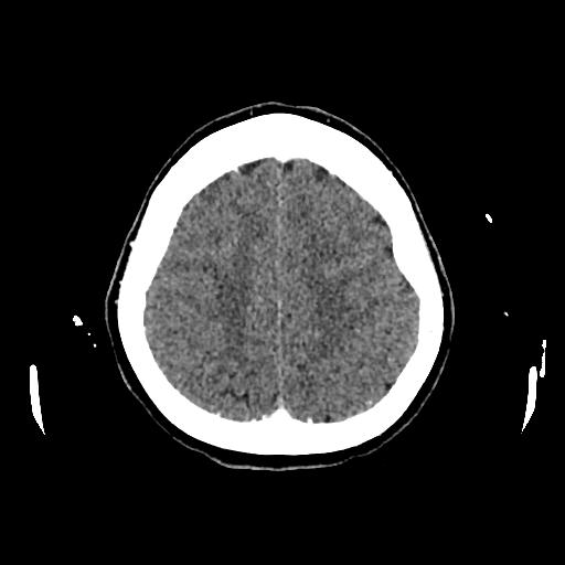 Cerebral venous thrombosis with venous hemorrhagic infarct (Radiopaedia 90354-107660 Axial with contrast 129).jpg