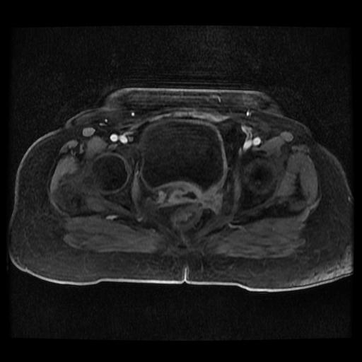 Cervical carcinoma (Radiopaedia 70924-81132 Axial T1 C+ fat sat 130).jpg