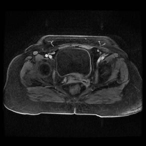 Cervical carcinoma (Radiopaedia 70924-81132 Axial T1 C+ fat sat 221).jpg