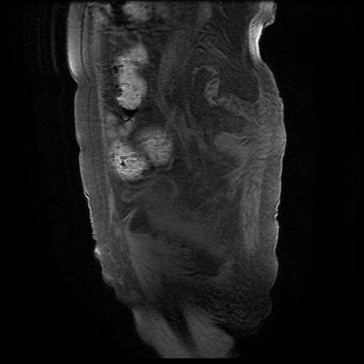 File:Cervical carcinoma (Radiopaedia 78847-91705 Sagittal T1 fat sat 13).jpg