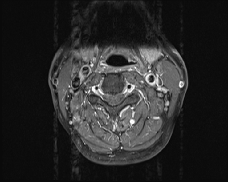 File:Cervical disc extrusion (Radiopaedia 53950-60077 Axial T1 C+ fat sat 7).jpg