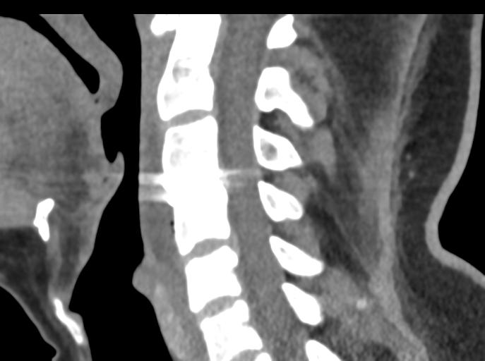 Cervical disc replacement (Radiopaedia 44025-47541 B 50).png