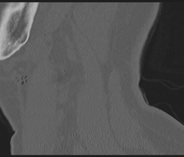 File:Cervical disc replacement (Radiopaedia 44025-47541 Sagittal bone window 74).png