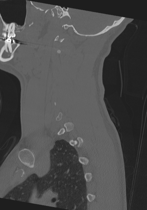 Cervical intercalary bone (Radiopaedia 35211-36748 Sagittal bone window 62).png