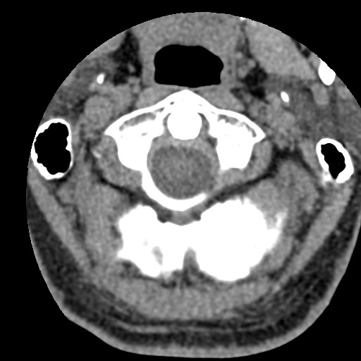 File:Cervical spinal neurofibroma in a patient with NF1 (Radiopaedia 58344-65464 Axial non-contrast 13).jpg