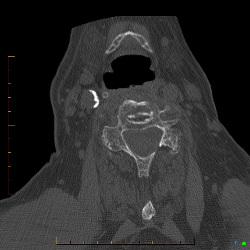File:Cervical spine fracture - ankylosing spondylitis (Radiopaedia 76835-88706 Axial bone window 126).jpg