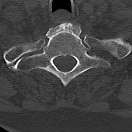 Cervical spine fracture - chalk stick (Radiopaedia 39116-41323 Axial bone window 81).png