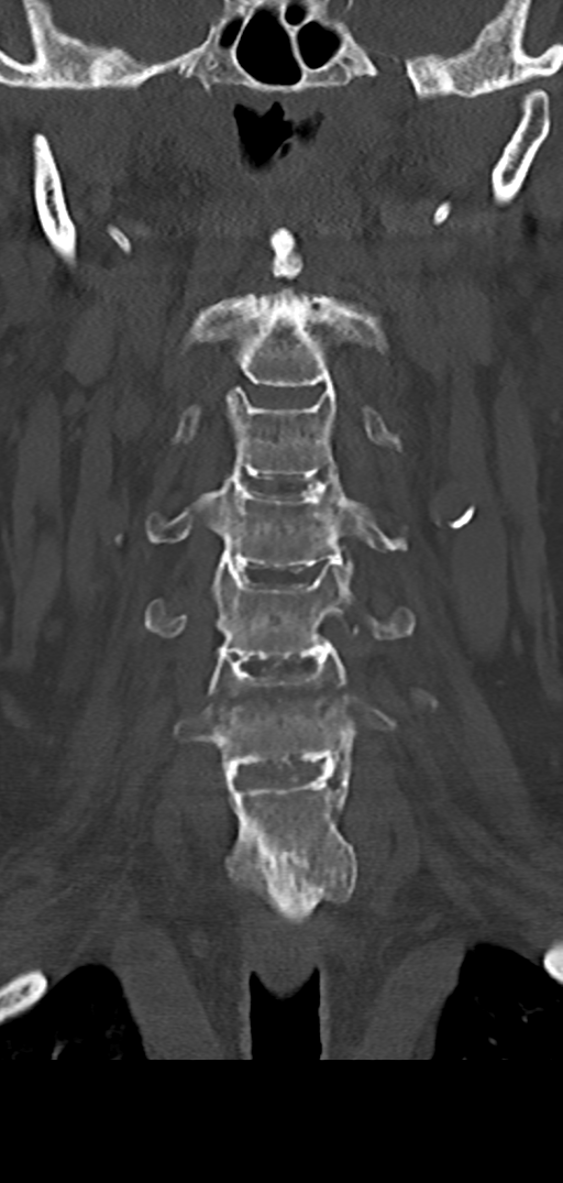 Cervical spine fracture - chalk stick (Radiopaedia 39116-41323 Coronal bone window 17).png