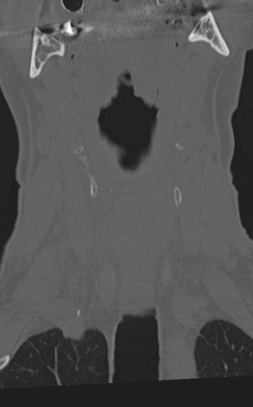 Cervical spine fractures with vertebral artery dissection (Radiopaedia 53296-59268 Coronal bone window 14).png