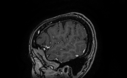 Cervical spondylodiscitis and calvarial hemangioma (Radiopaedia 64317-73103 Sagittal T1 C+ 9).jpg