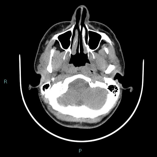 Cervical thymic cyst (Radiopaedia 88632-105335 Axial non-contrast 103).jpg