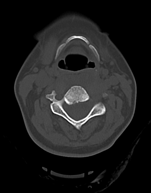 Cervical tuberculous spondylitis (Radiopaedia 39149-41365 Axial bone window 23).png
