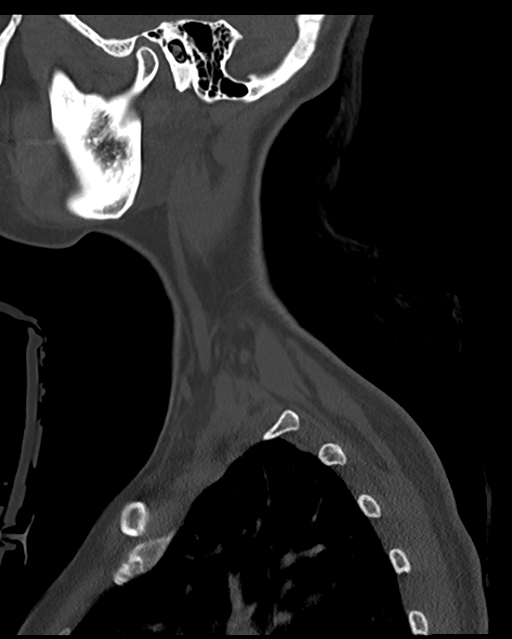Cervical tuberculous spondylitis (Radiopaedia 39149-41365 Sagittal bone window 7).png