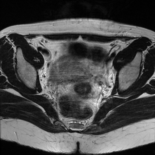 File:Cesarian section scar endometriosis (Radiopaedia 66520-75799 Axial T2 12).jpg