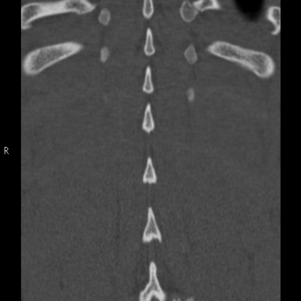 File:Chance fracture (Radiopaedia 36521-38081 Coronal bone window 57).jpg