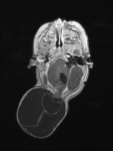 Chiari III malformation with occipital encephalocele (Radiopaedia 79446-92559 Axial T1 C+ mpr 35).jpg