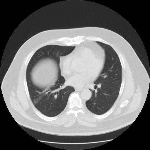 File:Chilaiditi’s syndrome (Radiopaedia 27550-27756 Axial lung window 4).jpg