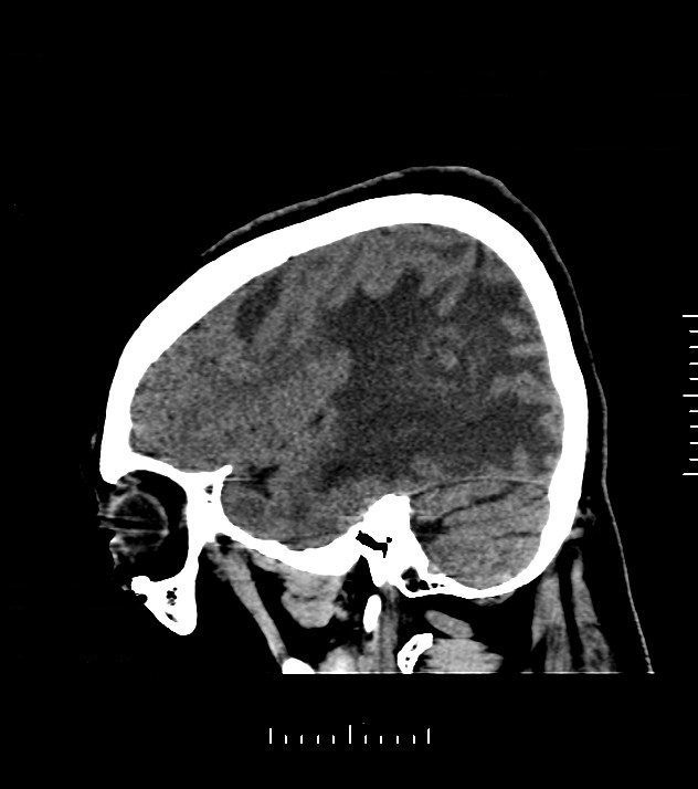 Cholangiocarcinoma with cerebral metastases (Radiopaedia 83519-98628 C 12).jpg