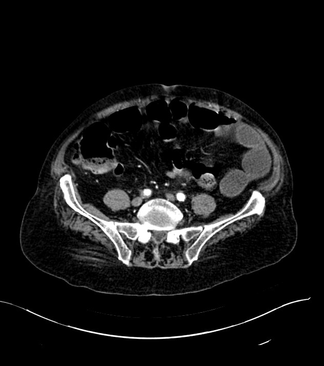Cholangiocarcinoma with cerebral metastases (Radiopaedia 83519-98629 B 85).jpg