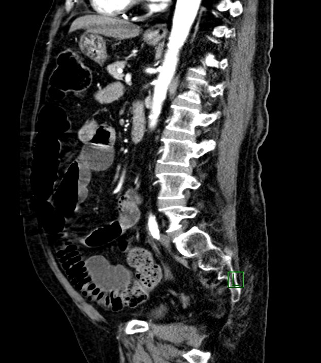 Cholangiocarcinoma with cerebral metastases (Radiopaedia 83519-98629 F 54).jpg