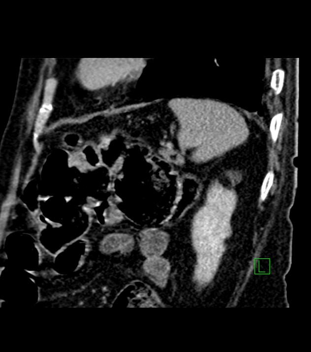 Cholangiocarcinoma with cerebral metastases (Radiopaedia 83519-98629 Sagittal C+ delayed 26).jpg